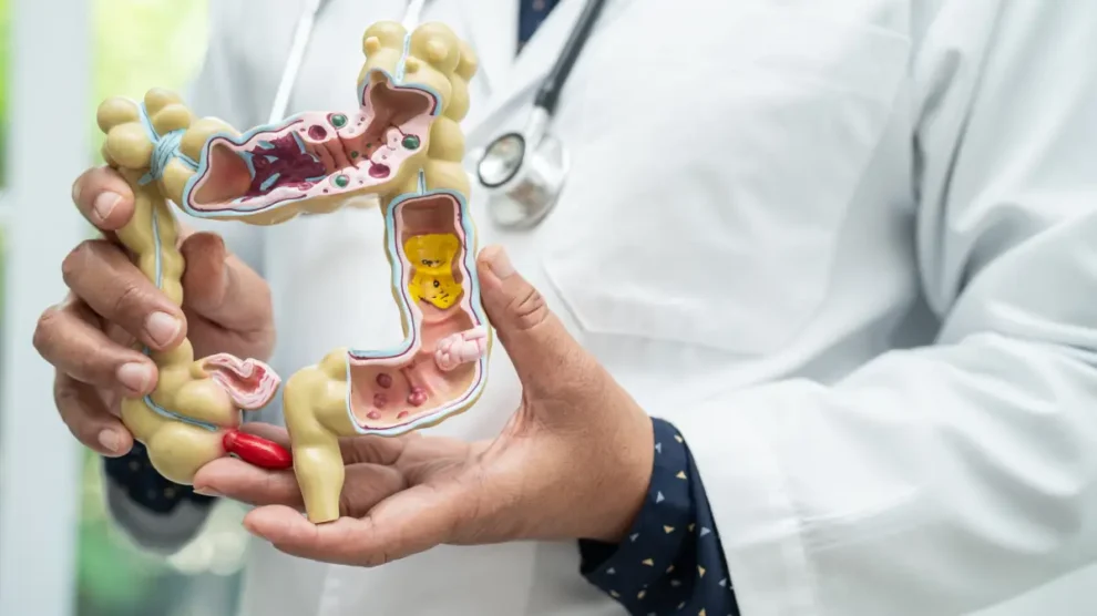 Câncer intestinal: prevenção, diagnóstico e tratamento