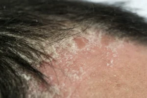 Doenças dermatológicas do couro cabeludo: veja as principais