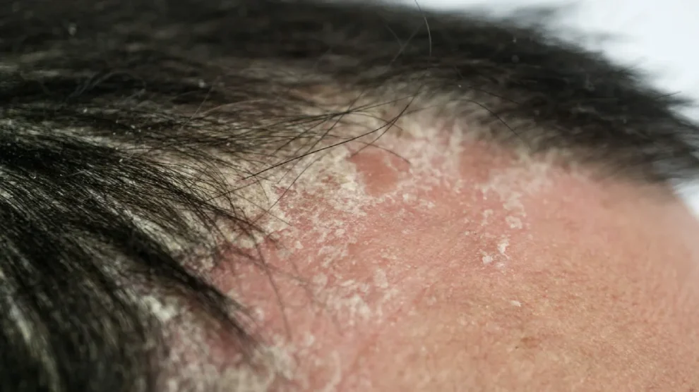 Doenças dermatológicas do couro cabeludo: veja as principais