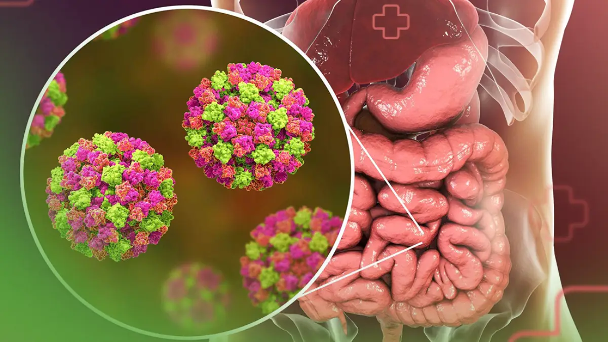 Norovírus: o que é, como identificar os sintomas e prevenir a infecção
