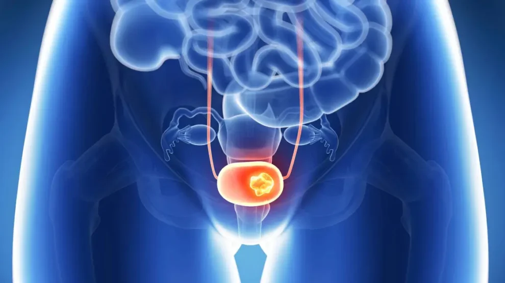 Hiperplasia prostática benigna: quando o aumento da próstata passa a ser um problema