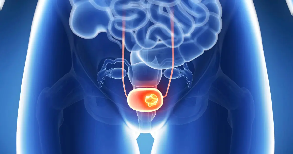 Hiperplasia prostática benigna: quando o aumento da próstata passa a ser um problema